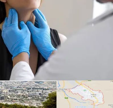 دکتر سرطان گلو در یاسوج