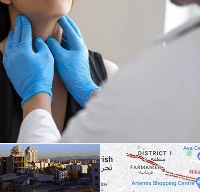 دکتر سرطان گلو در فرمانیه 