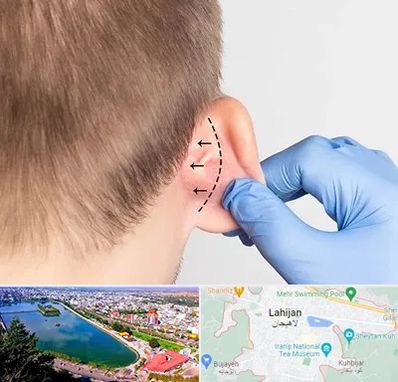 عمل زیبایی گوش در لاهیجان