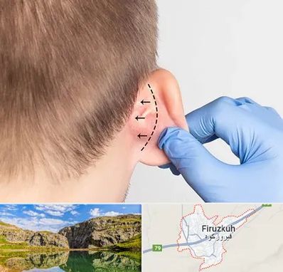 عمل زیبایی گوش در فیروزکوه