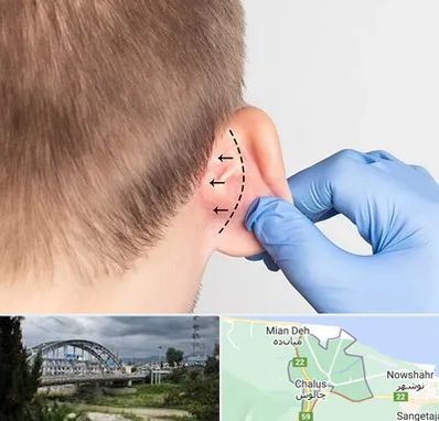 عمل زیبایی گوش در چالوس