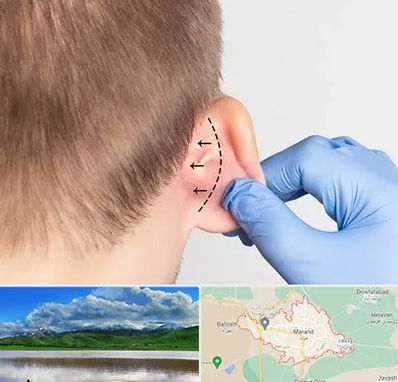 عمل زیبایی گوش در مرند