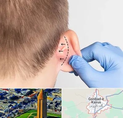عمل زیبایی گوش در گنبد کاووس