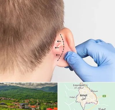 عمل زیبایی گوش در آمل