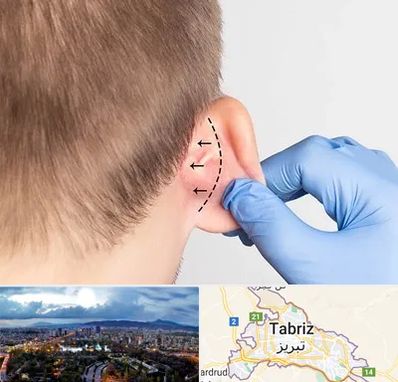 عمل زیبایی گوش در تبریز