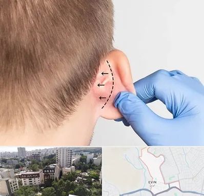 عمل زیبایی گوش در اوین