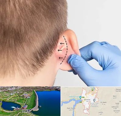 عمل زیبایی گوش در مهاباد