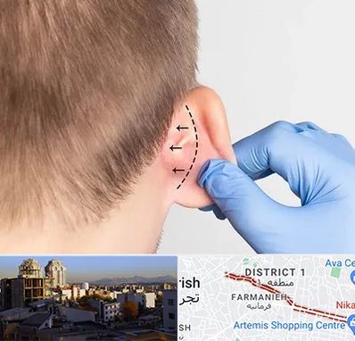 عمل زیبایی گوش در فرمانیه