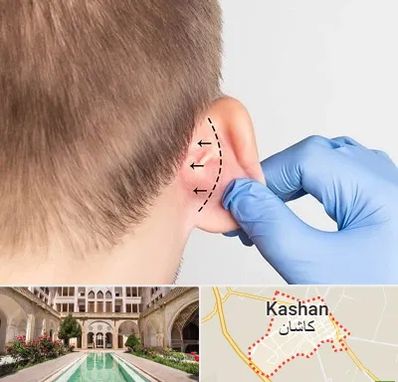 عمل زیبایی گوش در کاشان