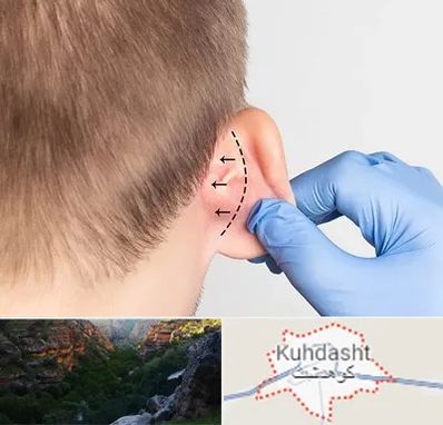عمل زیبایی گوش در کوهدشت