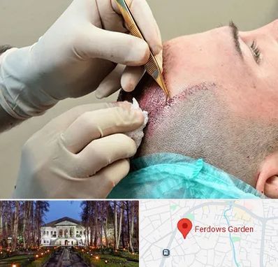 اسکالپ موی سر در باغ فردوس