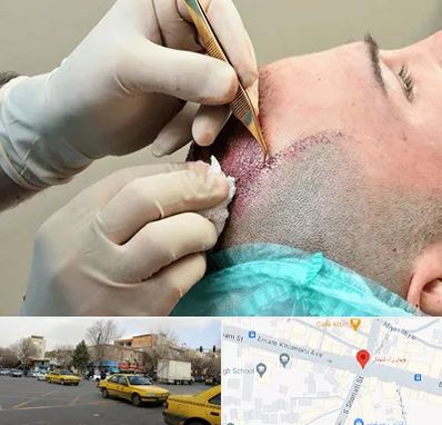 اسکالپ موی سر در شهناز تبریز