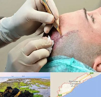 اسکالپ موی سر در بندرلنگه