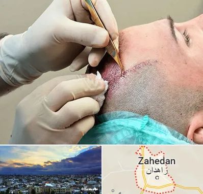 اسکالپ موی سر در زاهدان