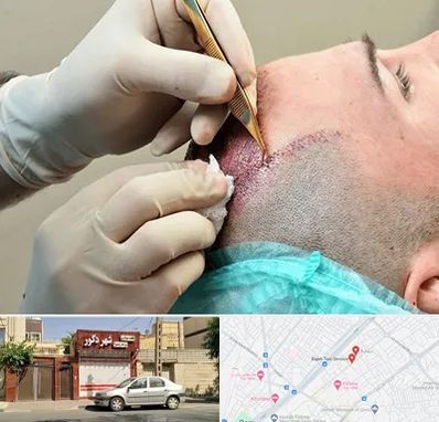 اسکالپ موی سر در باجک قم