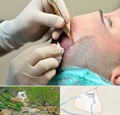 اسکالپ موی سر در کردان