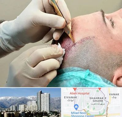 اسکالپ موی سر در شهرک غرب 