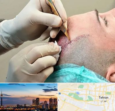 اسکالپ موی سر در غرب تهران 