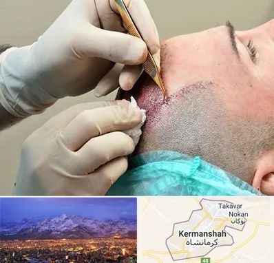 اسکالپ موی سر در کرمانشاه