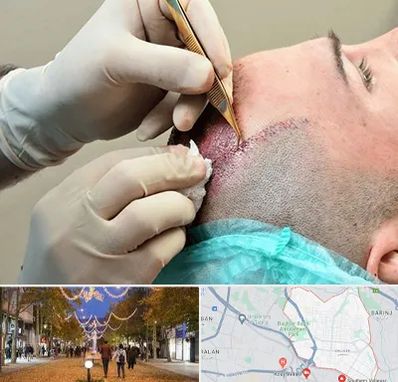 اسکالپ موی سر در ولیعصر ارومیه