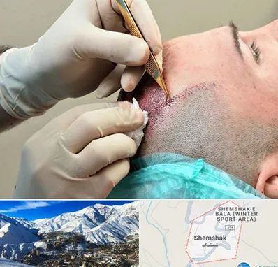 اسکالپ موی سر در شمشک