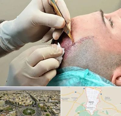 اسکالپ موی سر در قزوین