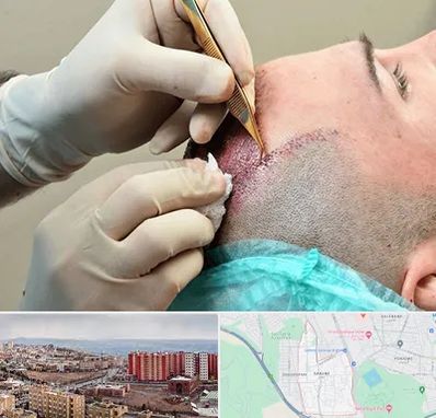 اسکالپ موی سر در سهند تبریز