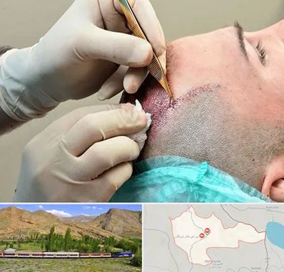 اسکالپ موی سر در خاش