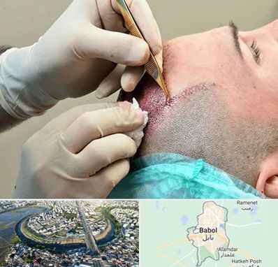 اسکالپ موی سر در بابل