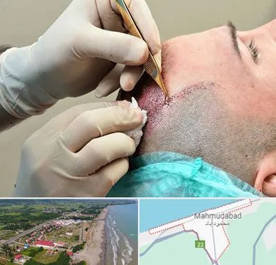 اسکالپ موی سر در محمودآباد