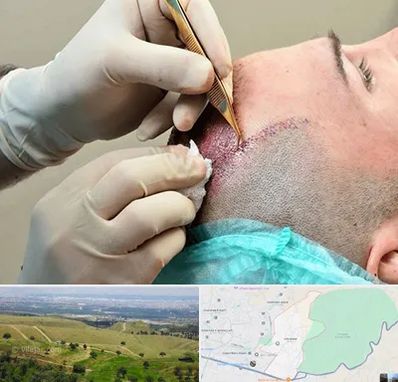 اسکالپ موی سر در سوهانک