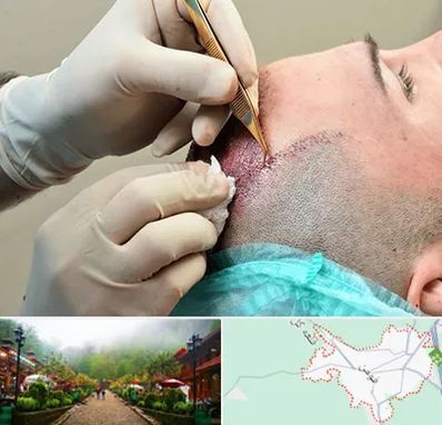 اسکالپ موی سر در فومن