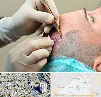 اسکالپ موی سر در قاسم آباد مشهد 