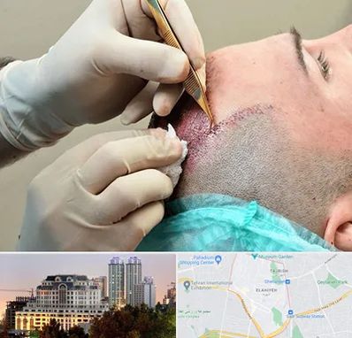 اسکالپ موی سر در فرشته 