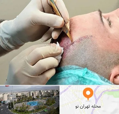 اسکالپ موی سر در تهران نو