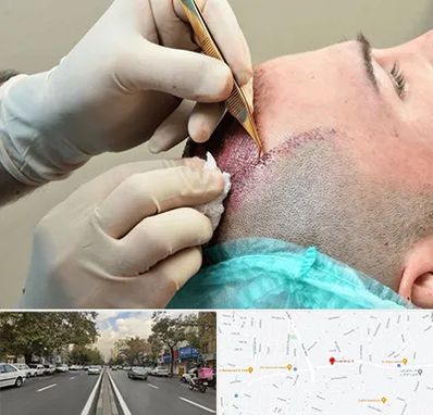 اسکالپ موی سر در دولت 