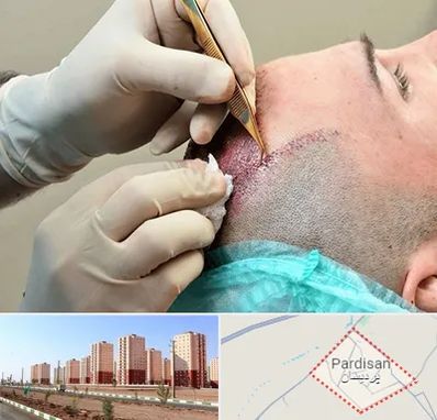 اسکالپ موی سر در پردیسان قم