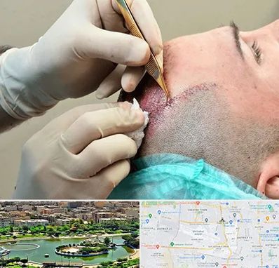 اسکالپ موی سر در منطقه 9 تهران 