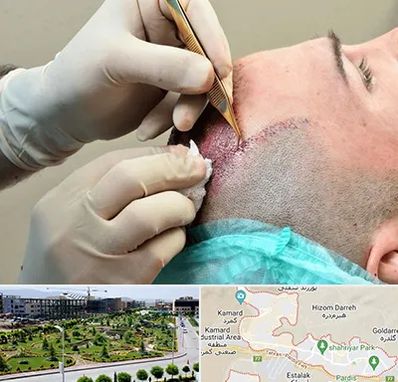 اسکالپ موی سر در پردیس