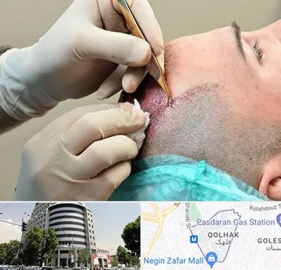 اسکالپ موی سر در قلهک 