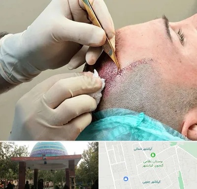 اسکالپ موی سر در کیانشهر