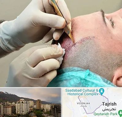 اسکالپ موی سر در زعفرانیه 