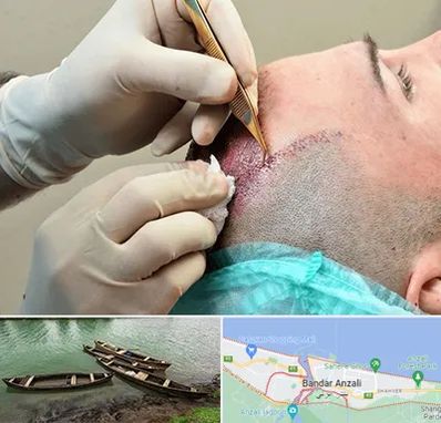 اسکالپ موی سر در بندر انزلی