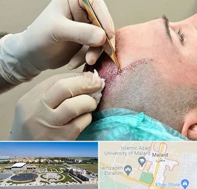 اسکالپ موی سر در ملارد