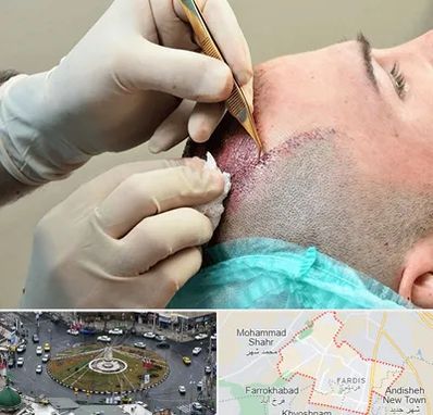 اسکالپ موی سر در فردیس کرج 