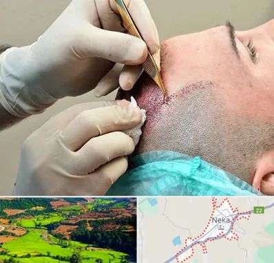 اسکالپ موی سر در نکا