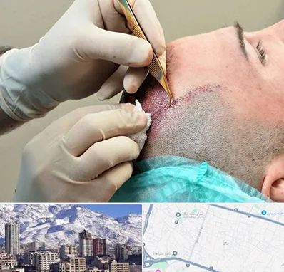 اسکالپ موی سر در ازگل