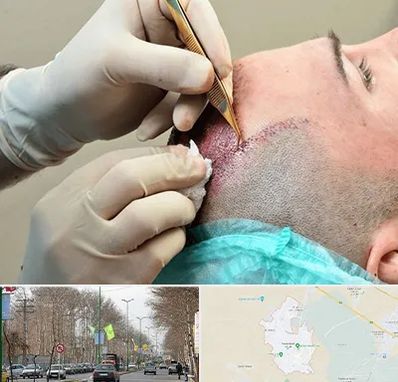 اسکالپ موی سر در نظرآباد کرج 