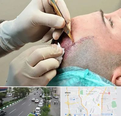 اسکالپ موی سر در ستارخان 