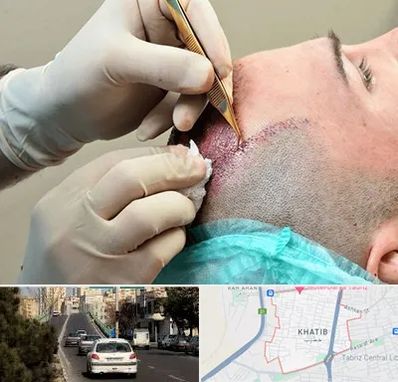 اسکالپ موی سر در خطیب تبریز
